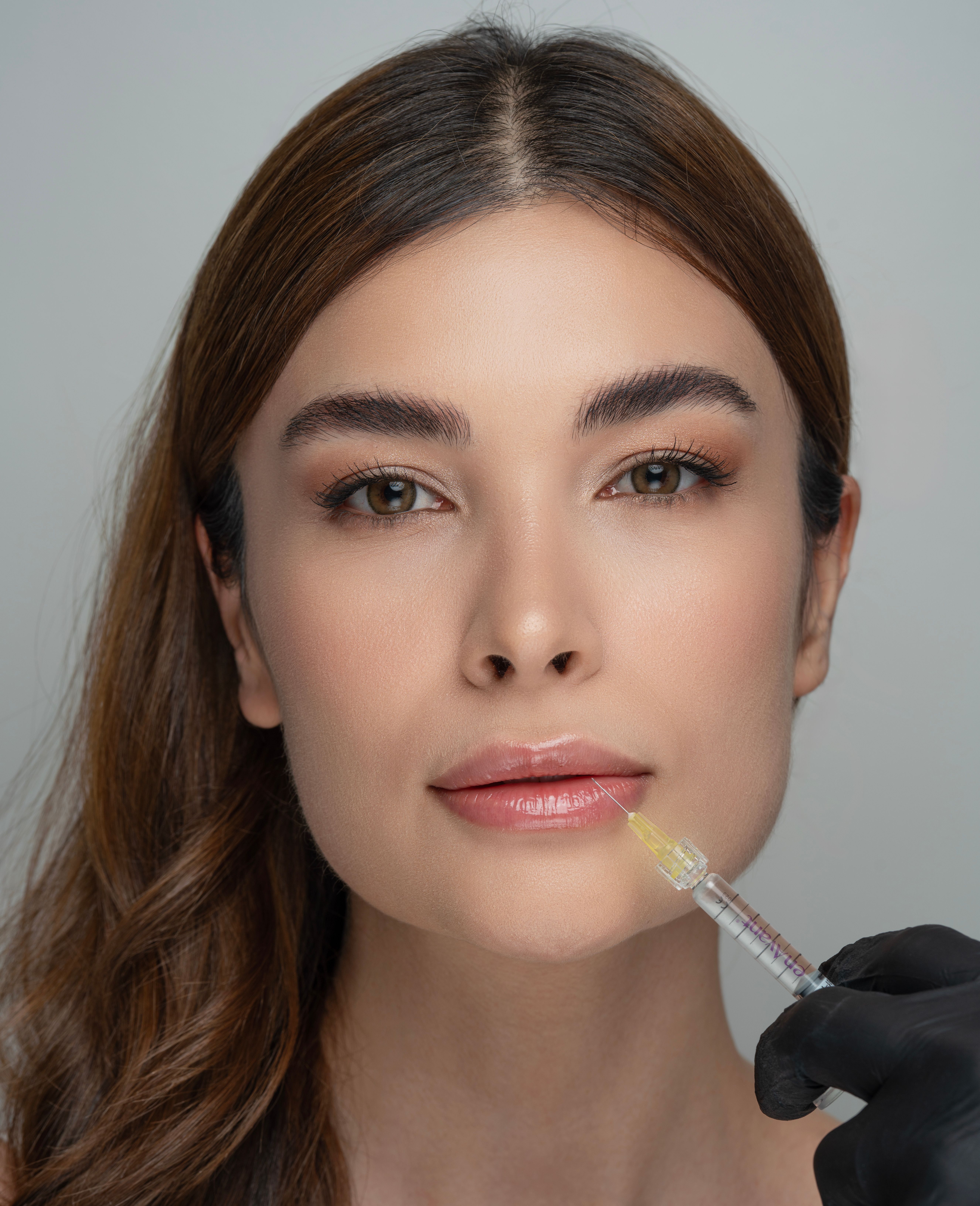 Lip Enhancement treatment result 2