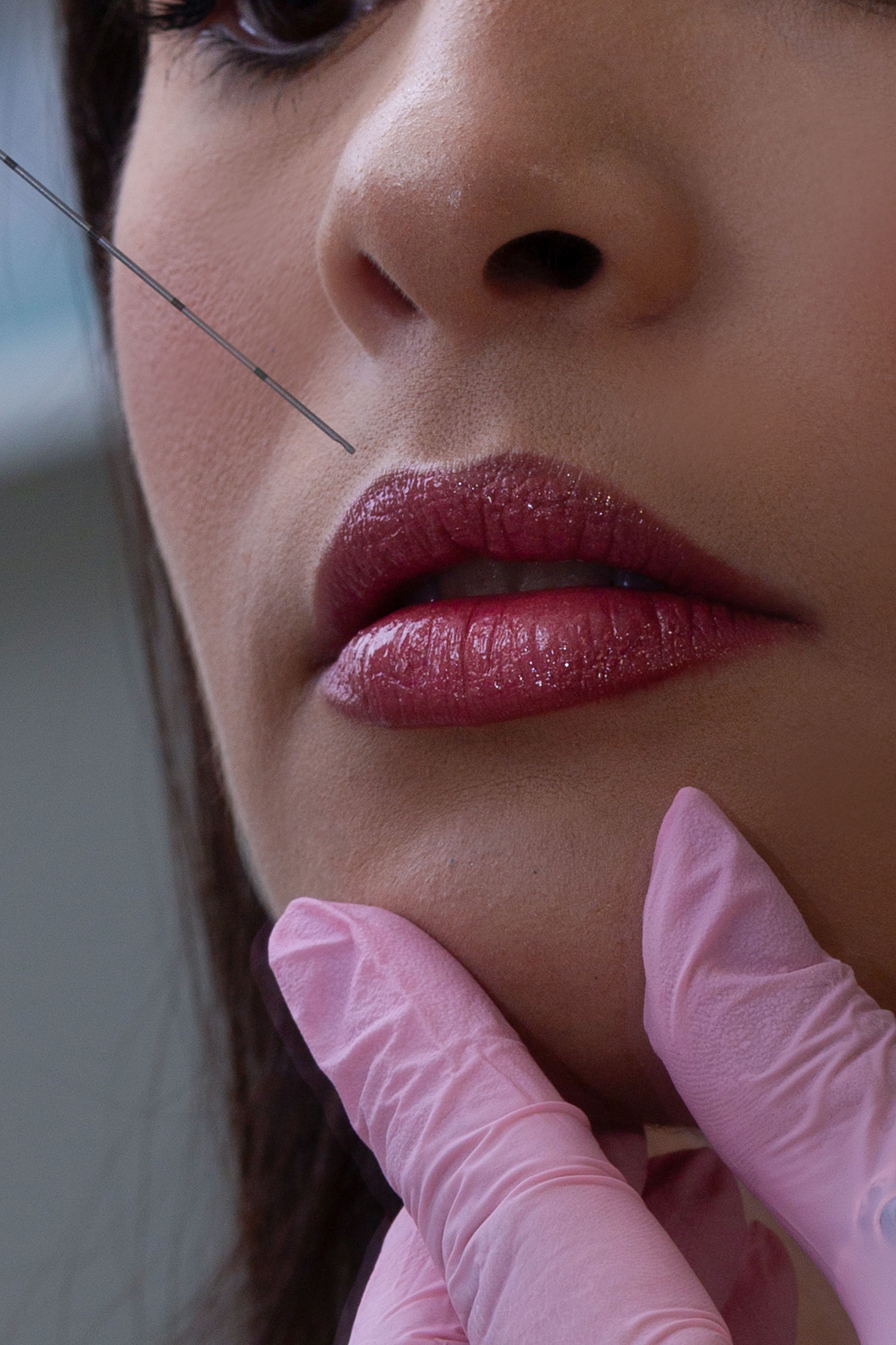 Lip Enhancement treatment result 3